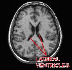 the lateral ventricles