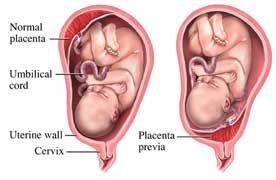 placenta previa